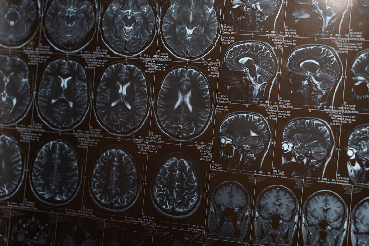Rows of brain MRI scans printed on film, showing axial and sagittal views of the head